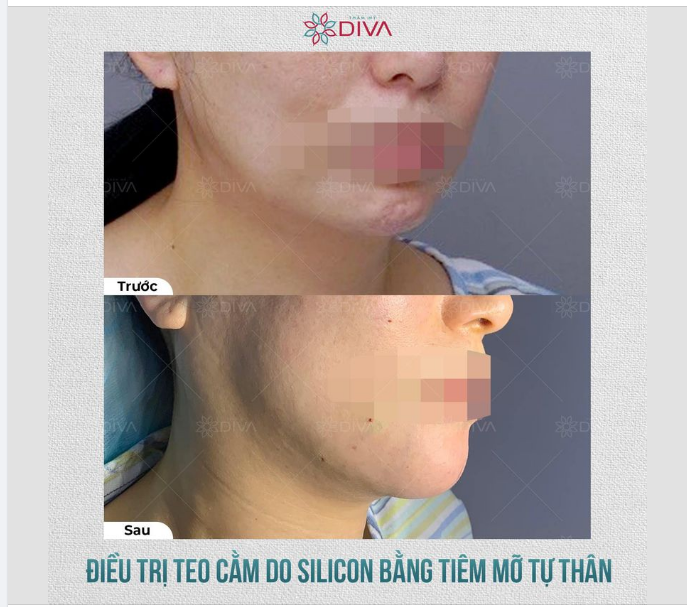 CẢI THIỆN CẰM NHĂN NHEO CO RÚM BẰNG PHƯƠNG PHÁP TIÊM MỠ COLEMAN