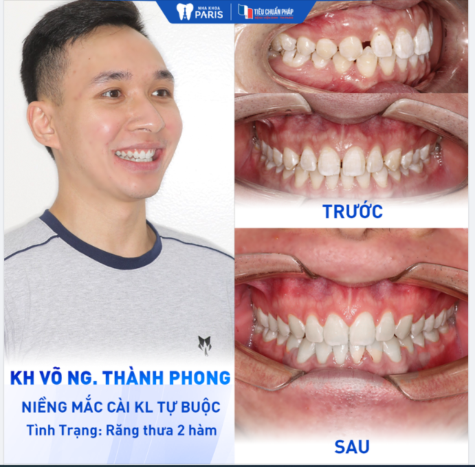 RĂNG THƯA HỞ KẼ  ĐỀU ĐẸP NGAY SAU KHI THÁO NIỀNG