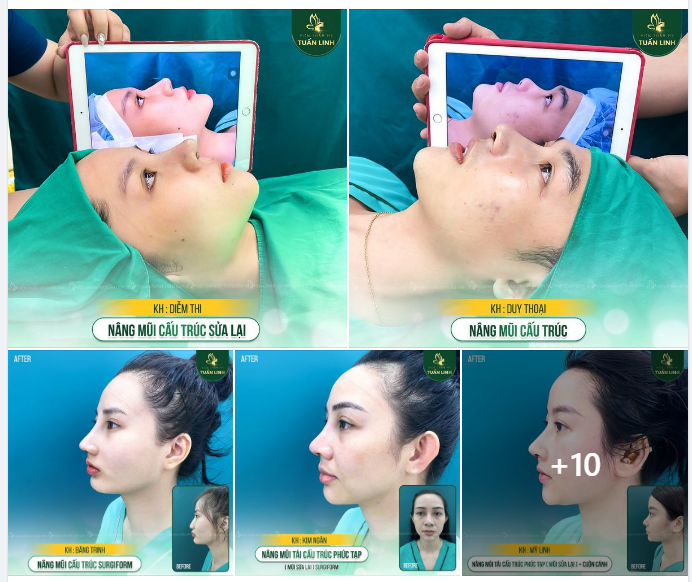 20 CA NÂNG MŨI TRONG 2 NGÀY - DÁNG MŨI ĐẸP NGAY SAU PHẪU THUẬT