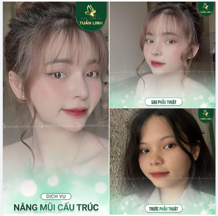 Một chiếc mũi cao xinh ''cứu'' cả gương mặt. Hài hòa, cân đối, xinh đẹp hơn, sắc nét và nổi bật hơn.