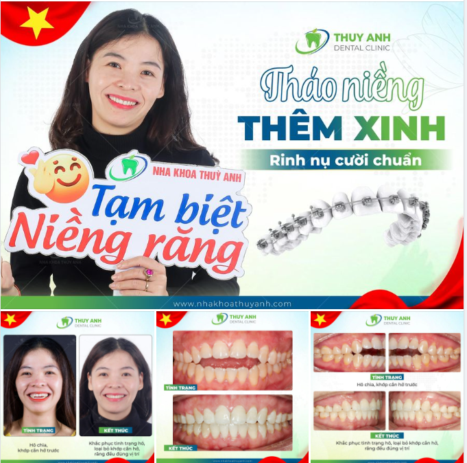 NIỀNG RĂNG ĐÓNG CẮN HỞ, CẢI THIỆN CHỨC NĂNG NĂNG ĂN NHAI VÀ THẨM MỸ CHO HÀM RĂNG