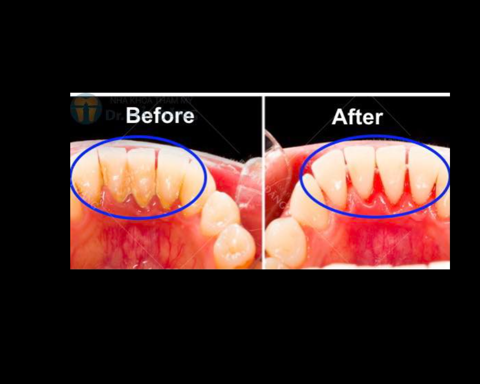 6 tháng, 1 năm hay còn lâu hơn thế nữa?
