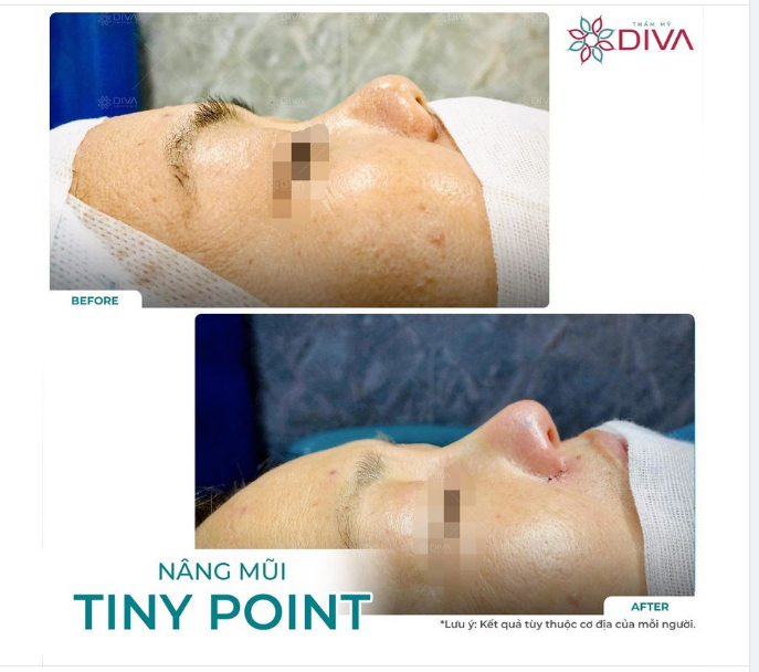 KẾT QUẢ NÂNG MŨI TINY POINT: MŨI CAO TỰ NHIÊN CÂN ĐỐI