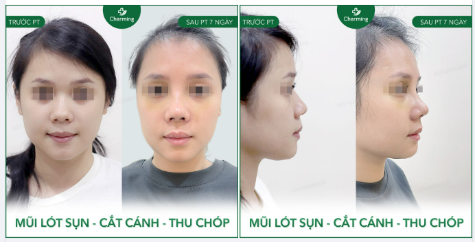 Bạn có bao giờ nghĩ rằng ngay cả những người mũi cao cũng cần nâng mũi không?