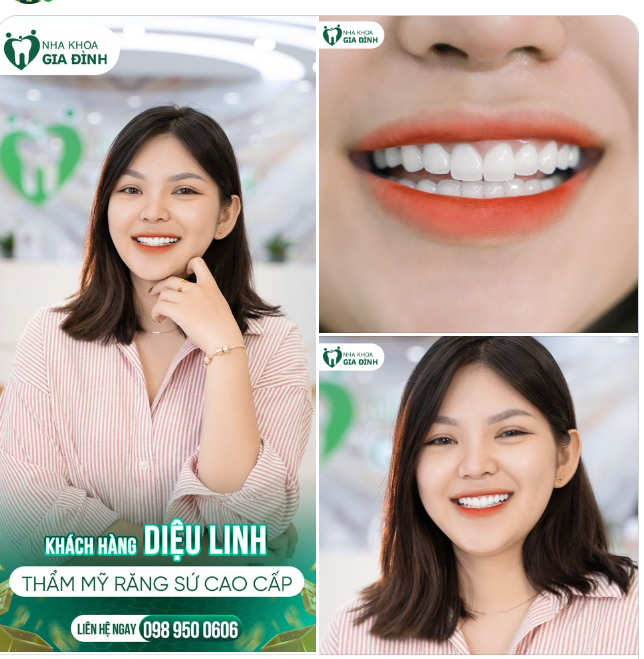 RĂNG YẾU ​​​​​​​THIẾU CANXI  ĂN NHAI KHÓ - KHẮC PHỤC CHỈ SAU 2 LẦN HẸN