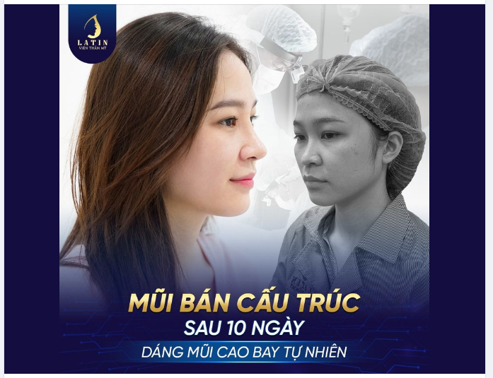 MŨI BÁN CẤU TRÚC CAO TỰ NHIÊN CHO EM GÁI L.T