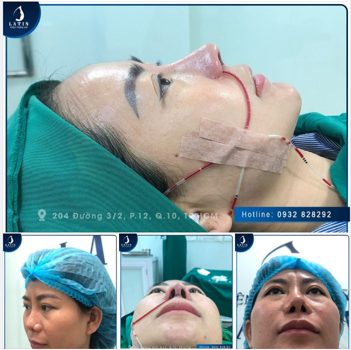 Đã bao nhiêu bạn nâng mũi nhưng không thành công rồi ạ?