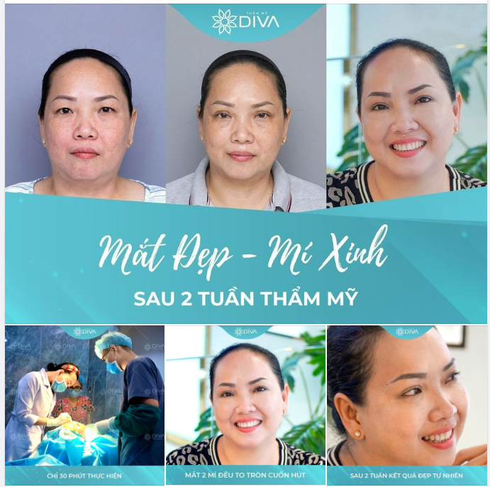 MẮT ĐẸP, MÍ XINH SAU 2 TUẦN THẨM MỸ