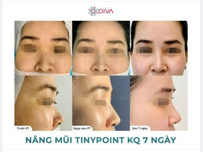 KẾT QUẢ SAU 7 NGÀY NÂNG MŨI