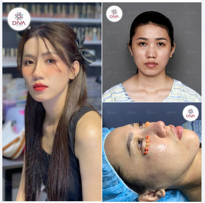 ĐẸP TỰ NHIÊN CHUẨN NÉT NÀNG THƠ SAU NÂNG MŨI, CẤY MỠ, LẤY MỠ MÍ DƯỚI