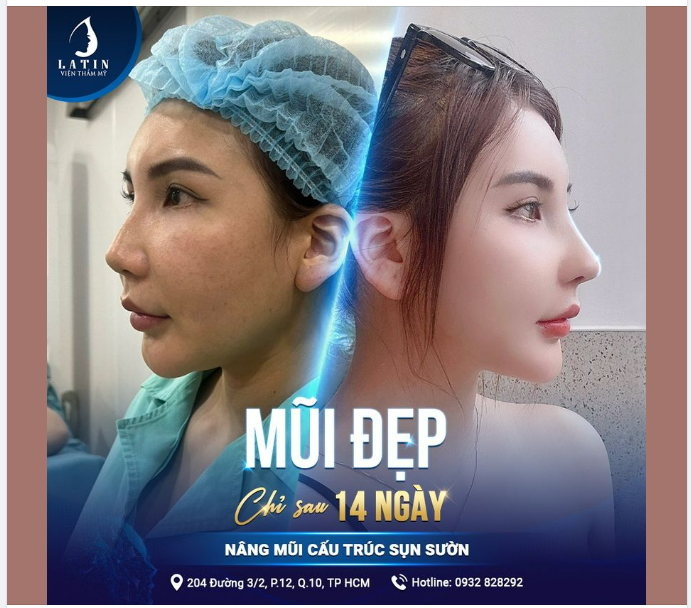 Khách hàng cực kỳ hài lòng với kết quả nâng mũi chỉ sau 14 ngày thực hiện!