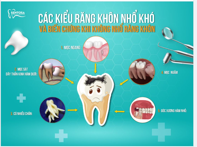 CÁC KIỂU RĂNG KHÔN NHỔ KHÓ VÀ BIẾN CHỨNG KHI KHÔNG NHỔ RĂNG KHÔN