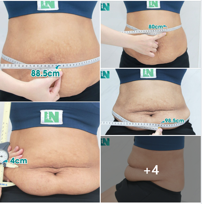 LẤY LẠI DÁNG VÓC CHO CHỊ KH CÓ BỤNG SỒ SỀ SAU 2 LẦN SINH NỞ, ĐƯỢC CHÍNH CHỊ GÁI GIỚI THIỆU EKIP BÁC SĨ LƯƠNG NGỌC. 