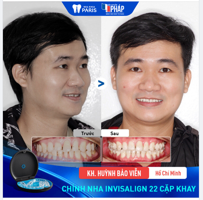 RĂNG ĐỀU ĐẸP SAU 22 CẶP KHAY INVISALIGN - KH HUỲNH BẢO VIỄN