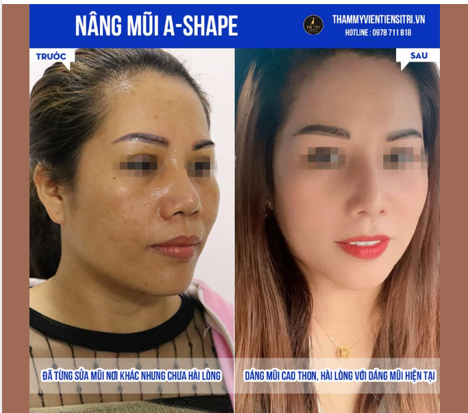 TỰ TIN HƠN NHỜ CHỈNH LẠI MŨI BẰNG DÁNG MŨI A-SHAPE