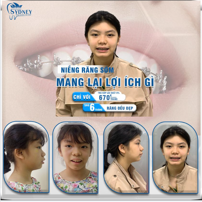 Độ tuổi vàng để niềng răng?