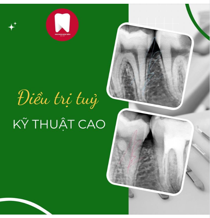 R7 SÂU BỊ HOẠI TỬ TUỶ - ĐIỀU TRỊ PHỨC TẠP