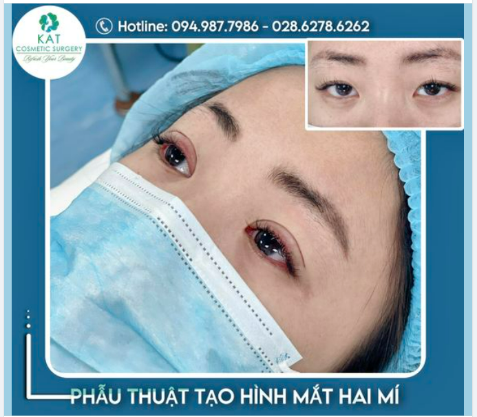 “Một đôi mắt đẹp có thể thay đổi thần thái gương mặt bạn như thế nào ”