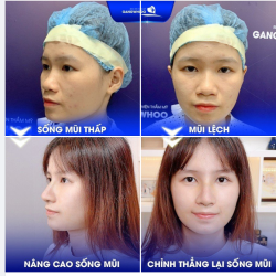 Nâng mũi Nanoform tại Bệnh viện thẩm mỹ Gangwhoo chính là giải pháp giúp khắc phục những chiếc mũi có nhiều khuyết điểm.