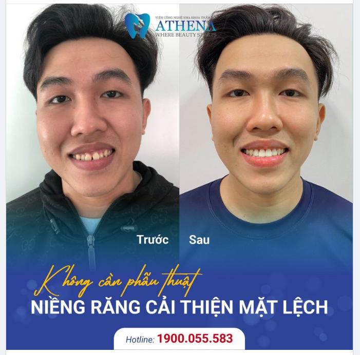 KHÔNG CẦN PHẪU THUẬT ​​​​​​​ NIỀNG RĂNG LÀ PHƯƠNG PHÁP CẢI THIỆN MẶT LỆCH NHANH CHÓNG VÀ TIẾT KIỆM CHI PHÍ!