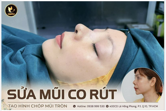SỬA MŨI CO RÚT – TẠO HÌNH CHÓP MŨI TRÒN