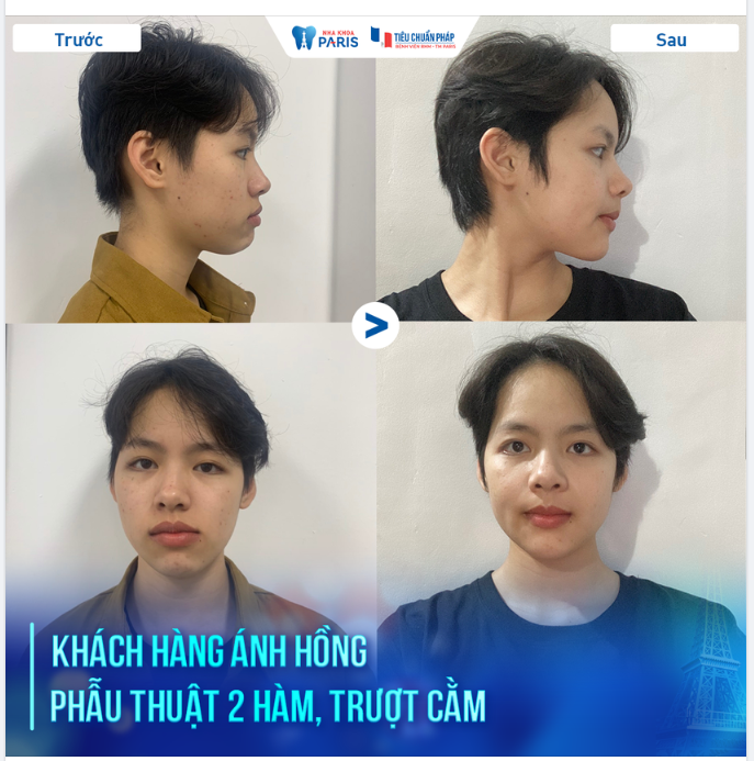 KH ÁNH HỒNG - PHẪU THUẬT 2 HÀM, TRƯỢT CẰM