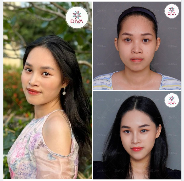 MẶT THON GỌN THU HÚT SAU THỰC HIỆN 4 DỊCH VỤ THẨM MỸ