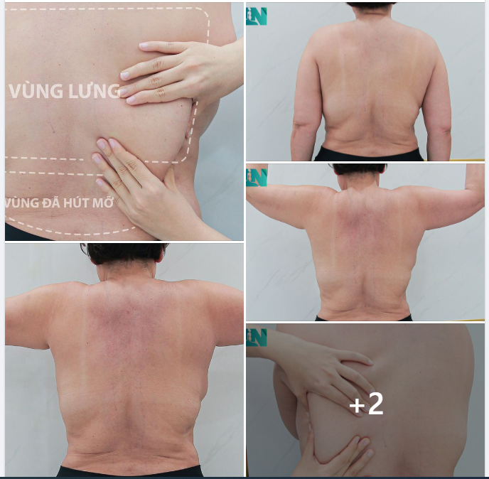  HÚT MỠ TẠO DÁNG THẨM MỸ CÁC VÙNG CÒN LẠI