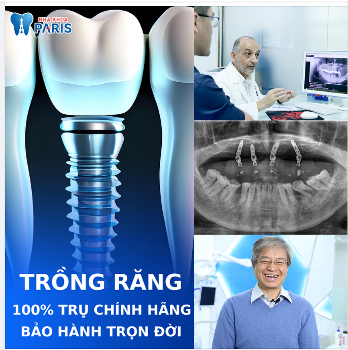 TRỒNG RĂNG IMPLANT CHUẨN BỆNH VIỆN PHÁP