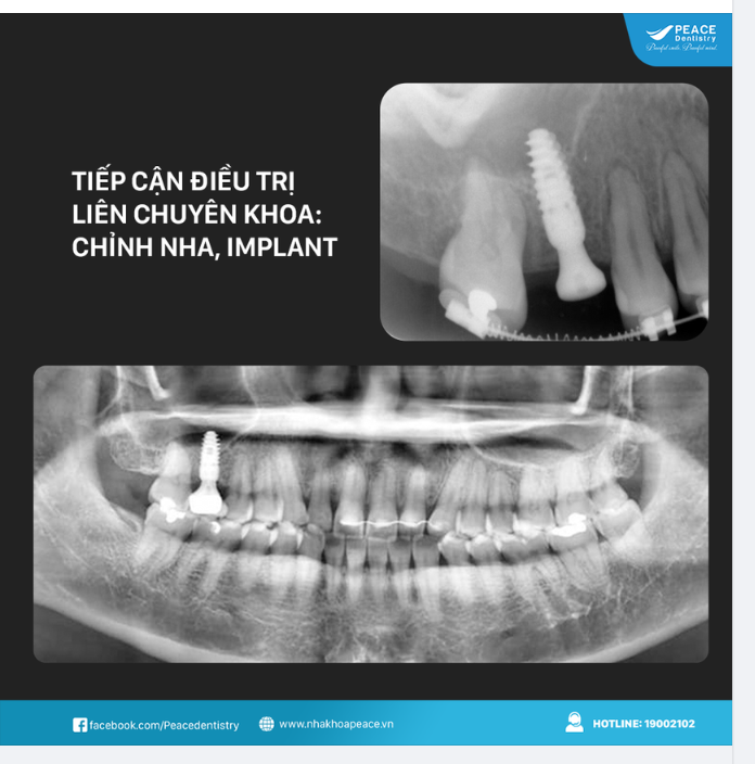 Dưới đây là một ca lâm sàng tại Peace Dentistry phối hợp giữa hai chuyên khoa chỉnh nha và cấy ghép implant.