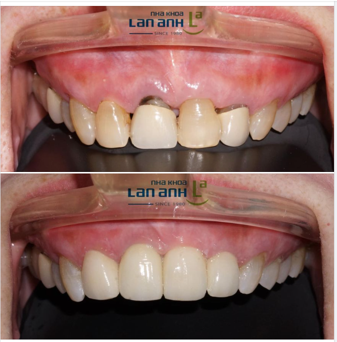 Hình ảnh một ca điều trị được thực hiện bởi Bác sĩ Nguyên Anh- chi nhánh 288/1 Huỳnh Văn Bánh, Phú Nhuận.