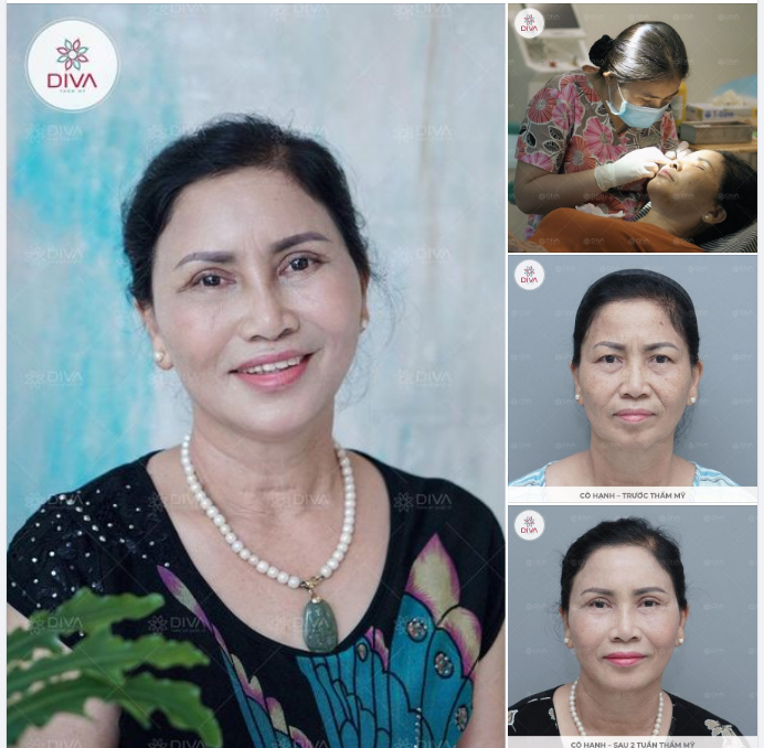 NHẤN MÍ MẮT: TÁI TẠO LẠI NẾP MÍ SỤP, CÓ DA DƯ THÀNH ĐÔI MẮT 2 MÍ ĐỀU, TỰ NHIÊN