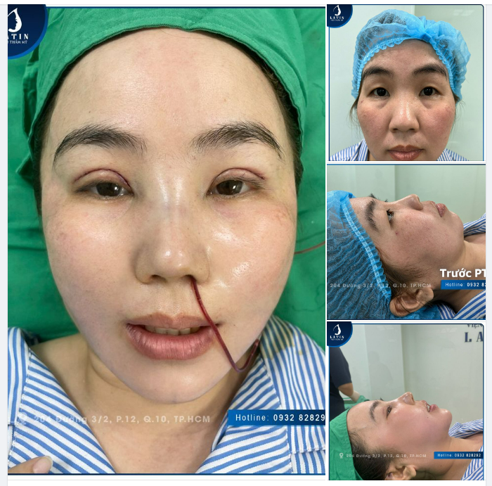 Chị khách hàng chưa từng làm gì, chưa từng đụng "dao kéo", nhưng vô cùng tin tưởng Latin và trọn gói combo mà không cần suy nghĩ: