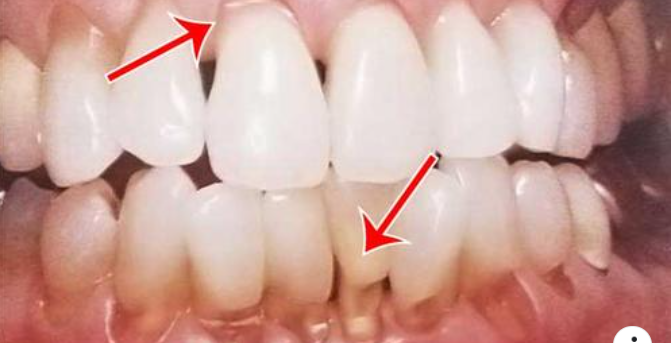 Răng mòn do chải răng không đúng cách