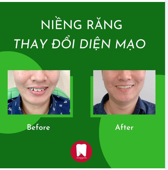 THAY ĐỔI DIỆN MẠO NHỜ NIỀNG RĂNG