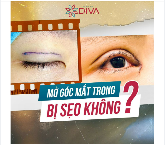 MỞ RỘNG GÓC MẮT CÓ ĐỂ LẠI SẸO