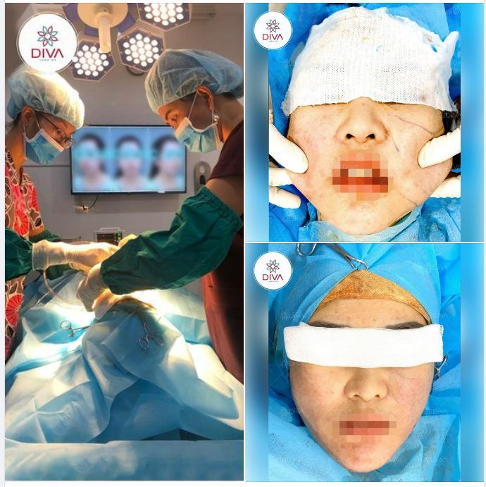 SAU GIẢM MỠ MẶT - GƯƠNG MẶT NHẸ NHÀNG, THON GỌN