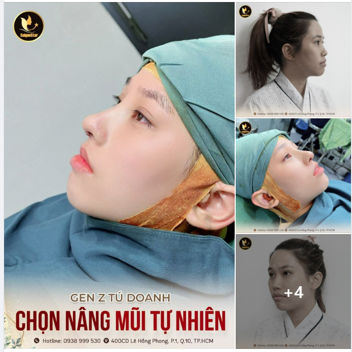 GEN Z TÚ DOANH CHỌN NÂNG MŨI TỰ NHIÊN