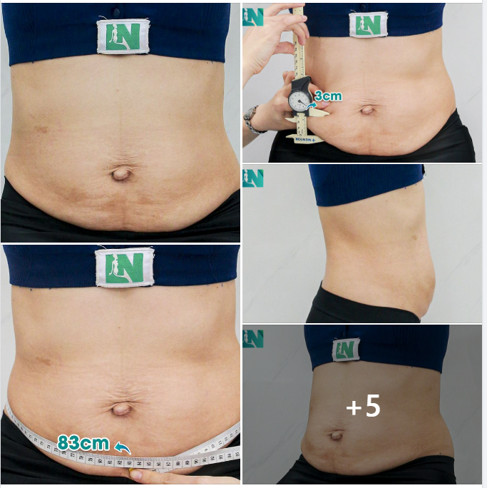  HÚT MỠ TẠO DÁNG THẨM MỸ CHO CHỊ KH 8X, TÌM LẠI DÁNG VÓC SAU SINH BẰNG GIẢI PHÁP AN TOÀN.