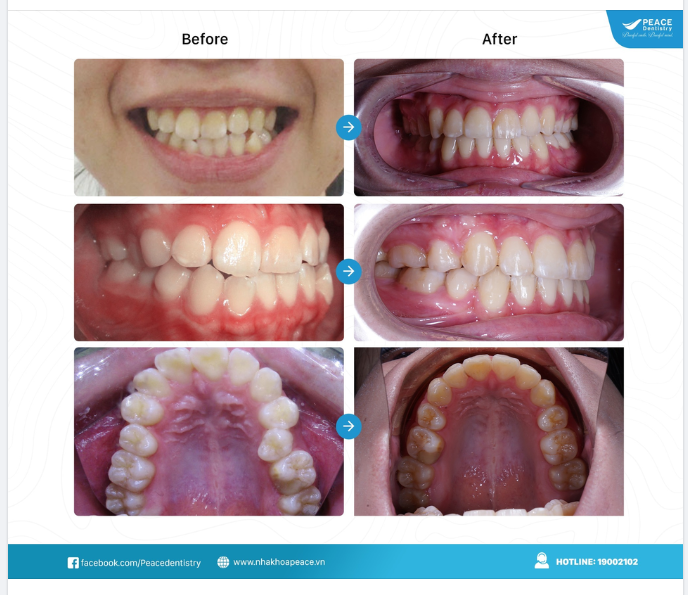 1,5 NĂM ĐỂ THAY ĐỔI NỤ CƯỜI TỰ TIN - BẠN ĐÃ SẴN SÀNG CHƯA?