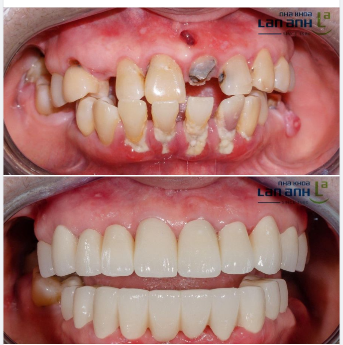 Hình ảnh một ca điều trị kết hợp phục hình sứ Direkt toàn hàm, do Bác sĩ Quốc Thắng- chi nhánh 288/1 Huỳnh Văn Bánh, Phú Nhuận thực hiện.