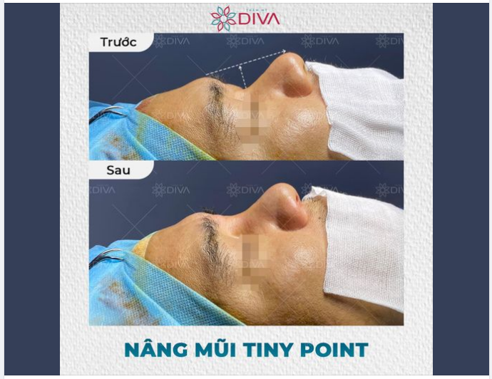 SÓNG MŨI THẤP, GÃY NGANG MẮT – GIẢI PHÁP LÀ GÌ?