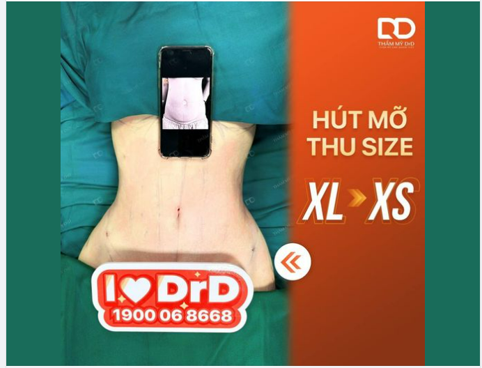 HÚT MỠ GIẢM SIZE - BYE BYE MỠ BỤNG