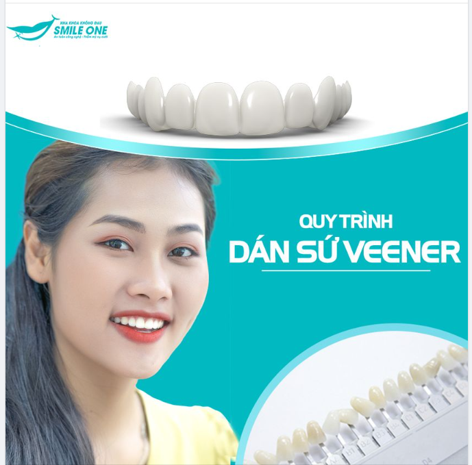 Quy trình dán veneer sứ tại Nha khoa Smile One được tiến hành qua các bước