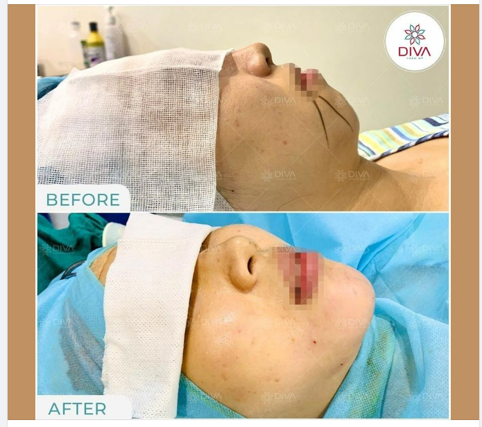 ĐIỀU TRỊ CẰM LẸM: SỞ HỮU CẰM VLINE VỚI TIÊM MỠ COLEMAN