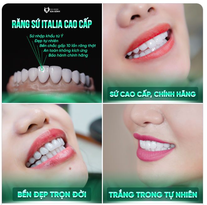 RĂNG SỨ ITALIA CAO CẤP KHÔNG MÀI NHỎ - BỀN ĐẸP - ĂN NHAI THOẢI MÁI
