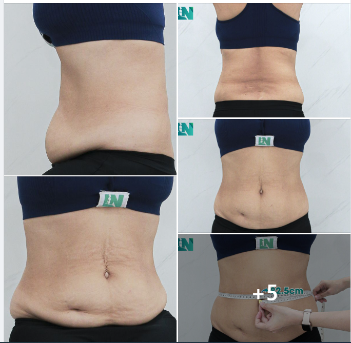  HÚT MỠ TẠO DÁNG THẨM MỸ CHO CHỊ KH 6X ĐẾN TỪ AN GIANG, ĐÃ THỰC HIỆN HÚT MỠ CÁNH TAY, LƯNG VÀ NÁCH HƠN 6 THÁNG TRƯỚC.
