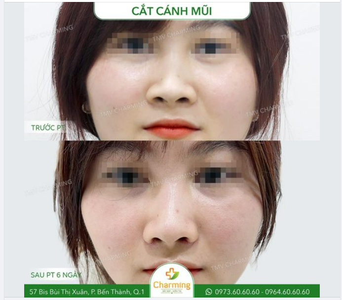 Đôi khi bạn không cần phải nâng mũi để điều chỉnh tỉ lệ khuôn mặt-mũi.