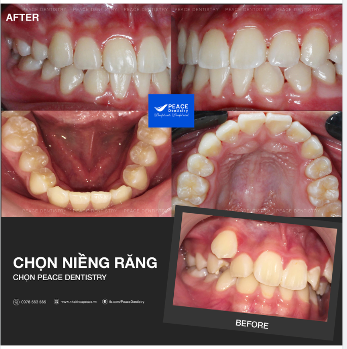 SAI LỆCH KHỚP CẮN DẪU KHÓ, CÓ INVISALIGN XỬ GỌN
