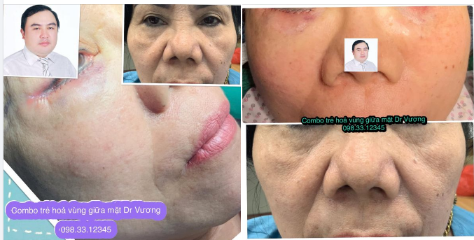 Trẻ hoá vùng giữa mặt chuyên sâu với Dr Vương: